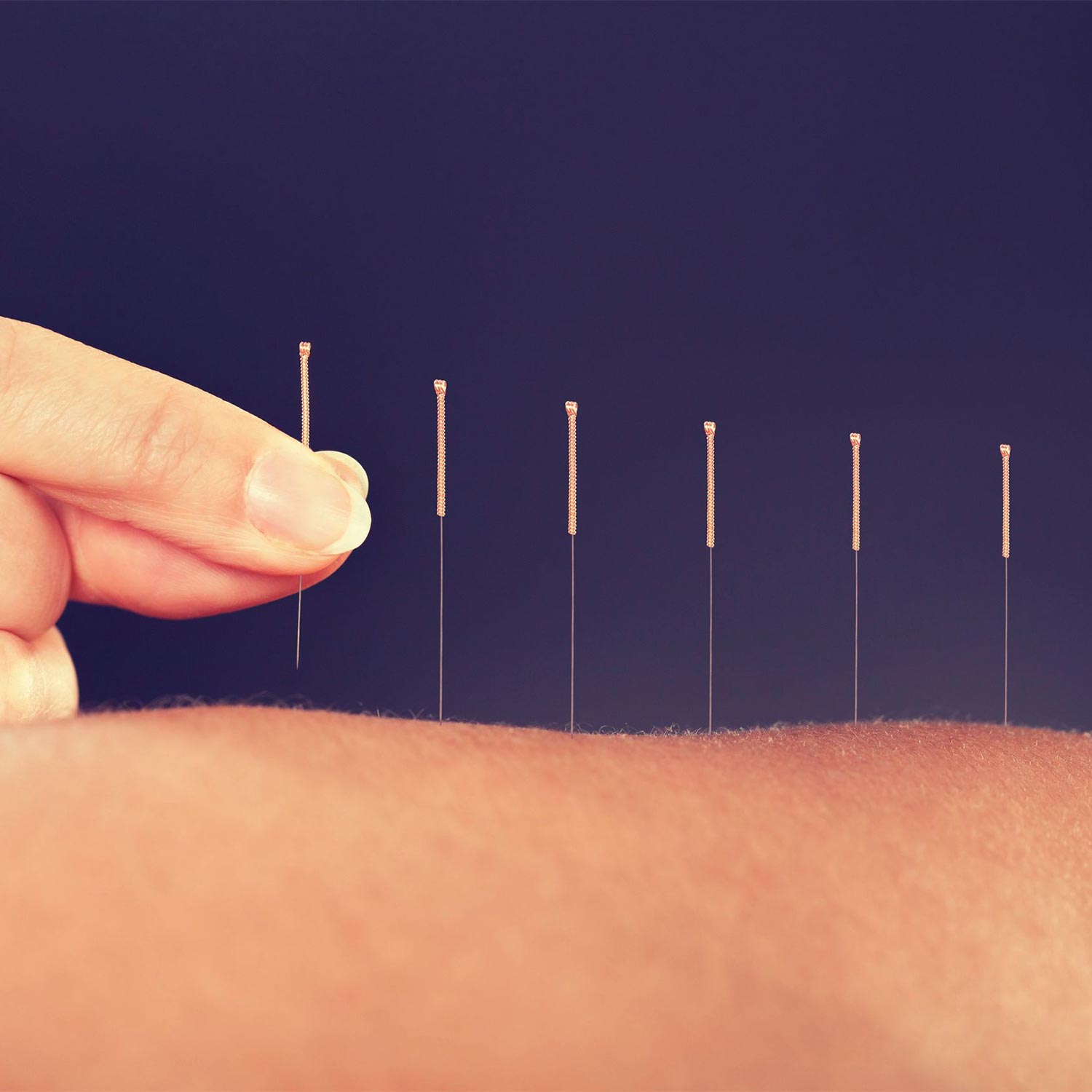 Illustration d'une séance acupuncture de la médecine chinoise pratiquée par M. Aklouchi au Centre Physio et Santé, cabinet de physiothérapie à Genève