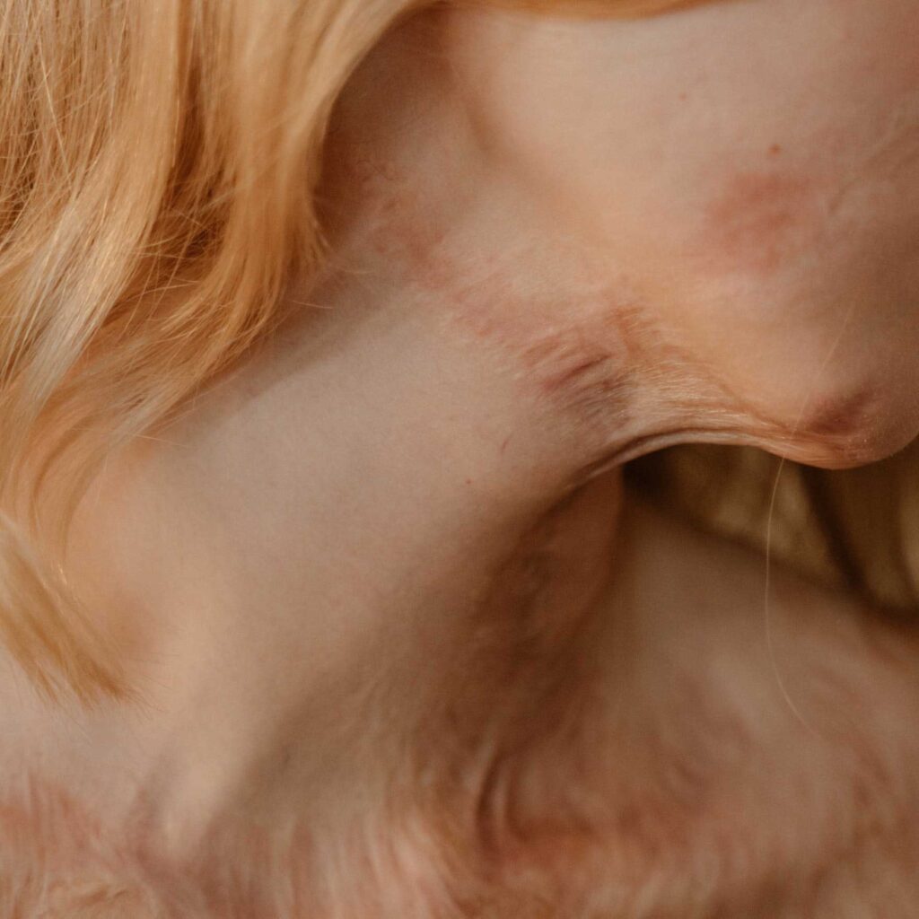cicatrices sur le visage et le cou à traiter avec la rééducation maxillo-faciale